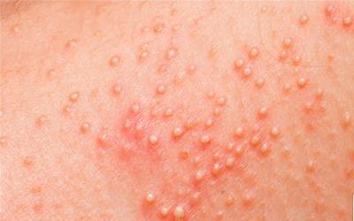 幼儿发烧后出疹子:全面解析及应对策略