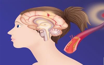 科学应对脑积水：关键药物及其作用机制详解