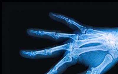 多发性骨髓瘤患者必看：饮食调理的五大原则，吃对食物助康复