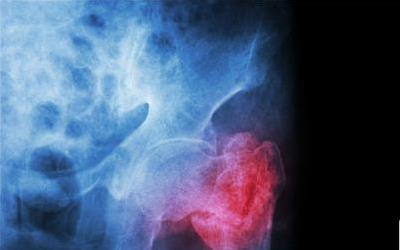 急性盆腔炎：深入了解其病因、症状及预防措施