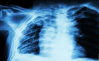 肺淋巴结肿大揭示的健康信号：原因与应对策略