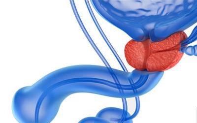 揭秘：前列腺增生症四大成因，男性健康不容忽视