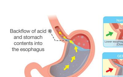 萎缩性胃炎按摩疗法：全面指南与实操步骤