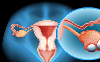 一侧多囊卵巢怀孕几率：揭秘怀孕成功率与备孕策略