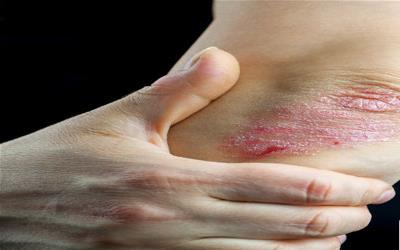 银屑病症状详解：全面了解银屑病的不同表现