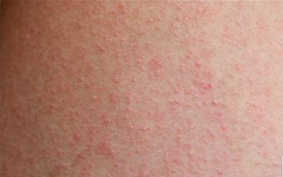 湿疹为什么不能擦牙膏