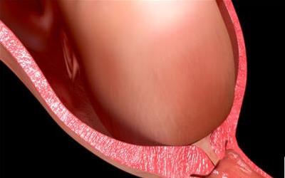 宫颈病毒感染：原因、症状及预防措施全面解析