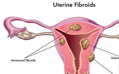 子宫内膜增生：揭秘原因、分类与预防措施