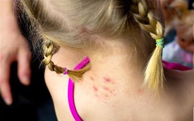 深度解析荨麻疹成因及科学应对策略