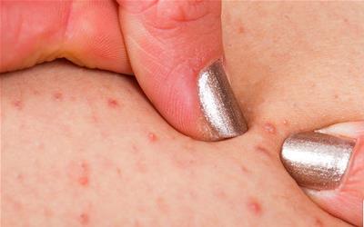 敏感肌肤毛孔粗大全方位解决方案：从护理到生活习惯