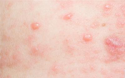 产后红疙瘩痒？3个专业方法快速缓解，别再忍着