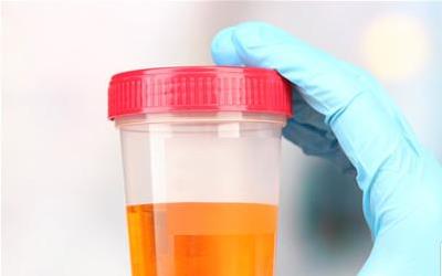 肉眼可见的血尿不容忽视：可能预示的严重健康问题解析