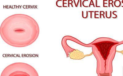子宫前后位：揭秘女性健康的关键因素
