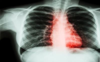 心肌炎恢复时间及注意事项全解析