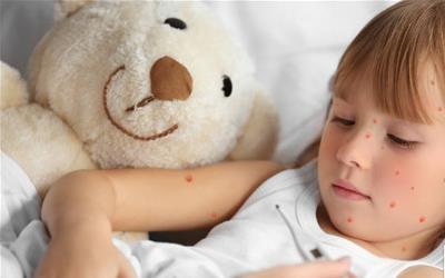 水痘隔离措施：保护孩子远离病毒的关键方法