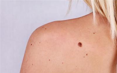 科学去除胎记的有效方法与注意事项