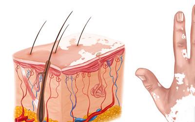 白癣治疗：全面指南与实用建议