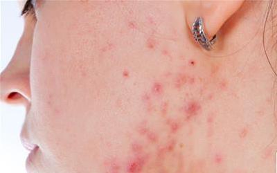 青春痘疤痕消除攻略：预防、治疗与护理全方位解析