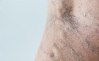 中医治疗精索静脉曲张：古老智慧与现代健康的新结合