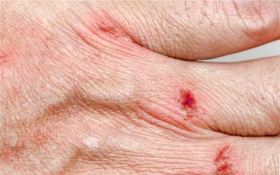 深度解析：疤痕组织增生的根源与科学防治策略