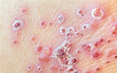 荨麻疹：全面揭秘治疗方法与预防措施