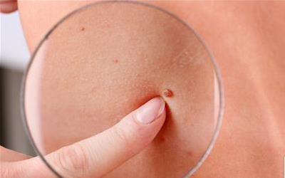 深入解析：增生性外毛根鞘瘤的病理特征及诊断方法