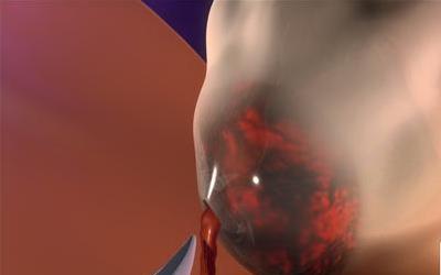 子宫小囊肿：全面解析与应对策略