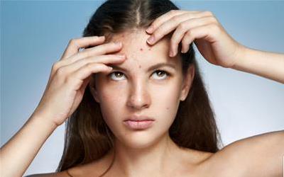 如何科学挤痘不留痕：全方位挤痘指南及注意事项