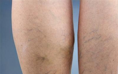 彻底告别腿上青筋：全面指南与实用建议