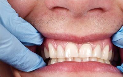 月子里刷牙牙龈出血：揭秘原因及预防措施