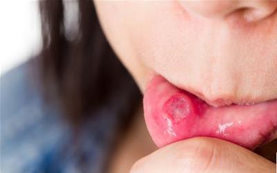 哺乳期乳头有白泡的科学处理方法与预防措施