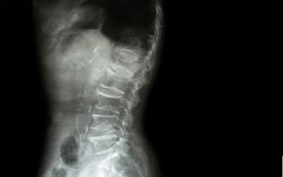 脚跟骨刺的全面治疗策略与日常护理指南