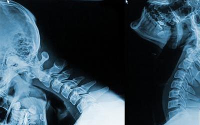 颈椎病引发胃疼？揭秘背后的神经机制与应对策略