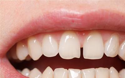 科学治疗牙齿发黄的有效方法全解析