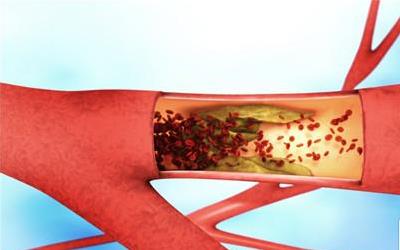 盲肠血管瘤：症状识别与治疗全解析