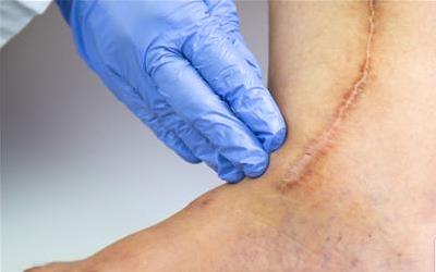 全方位揭秘：淡化疤痕的五大高效方法，让你的肌肤重焕光彩