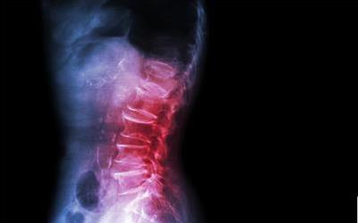 神经源性肿瘤：揭秘其成因、症状及应对策略