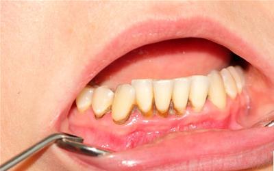 氟斑牙：成因、危害及预防方法全解析