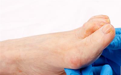 脚跟突出骨骼的日常保养方法与预防措施