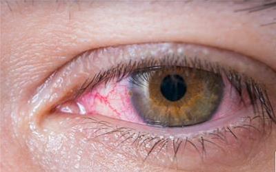 告别红血丝困扰：揭秘红血丝成因与科学祛除方法
