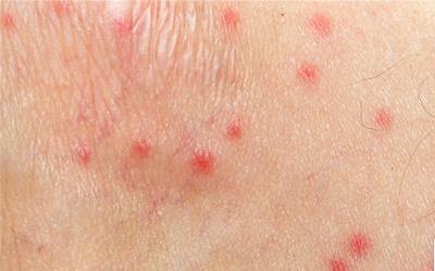 夏日防蚊攻略：蚊子叮咬起红点，如何有效缓解瘙痒与消肿