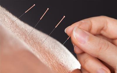 针灸减肥：揭秘高效穴位，助你轻松减脂