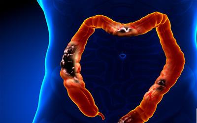 肠胃炎康复时间：影响因素及康复策略全解析